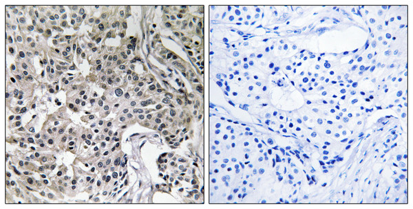 Immunohistochemistry analysis of paraffin-embedded human breast carcinoma tissue, using USP19 Antibody. The picture on the right is blocked with the synthesized peptide.