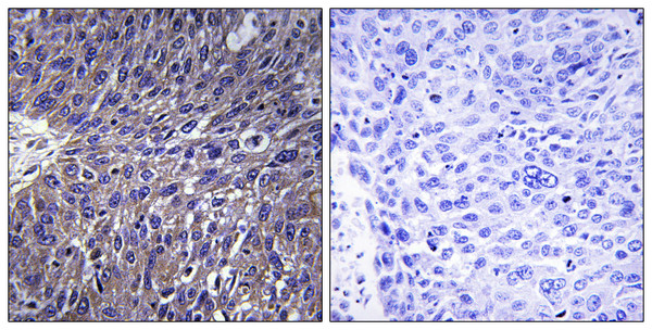 Immunohistochemistry analysis of paraffin-embedded human lung carcinoma tissue, using USP50 Antibody. The picture on the right is blocked with the synthesized peptide. Immunohistochemistry analysis of paraffin-embedded human lung carcinoma tissue, using USP50 Antibody. The picture on the right is blocked with the synthesized peptide.