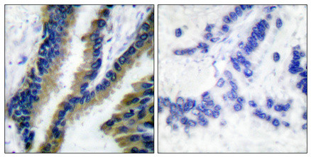 Immunohistochemical analysis of paraffin-embedded Human lung cancer. Antibody was diluted at 1:100 (4°C overnight). High-pressure and temperature Tris-EDTA, pH8.0 was used for antigen retrieval. Negetive contrl (right) obtaned from antibody was pre-absorbed by immunogen peptide.