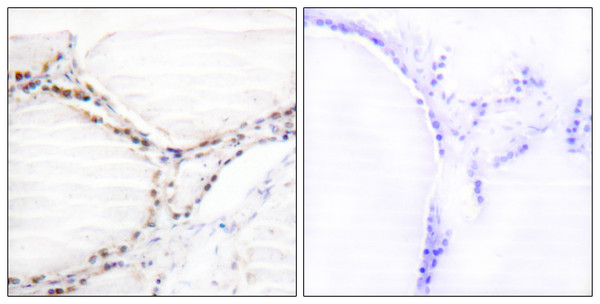 Immunohistochemistry analysis of paraffin-embedded human thyroid gland tissue, using Vitamin D Receptor Antibody. The picture on the right is blocked with the synthesized peptide. Immunohistochemistry analysis of paraffin-embedded human thyroid gland tissue, using Vitamin D Receptor Antibody. The picture on the right is blocked with the synthesized peptide.