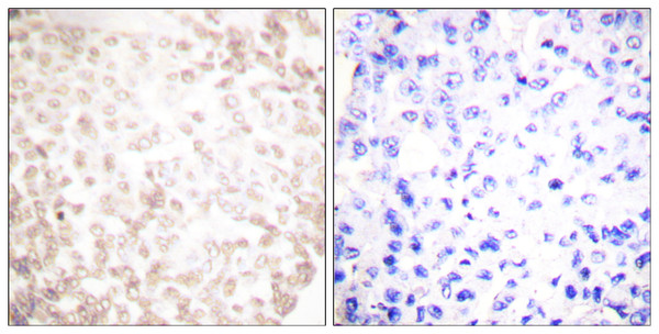 Immunohistochemistry analysis of paraffin-embedded human lung carcinoma tissue, using XRCC1 Antibody. The picture on the right is blocked with the synthesized peptide. Immunohistochemistry analysis of paraffin-embedded human lung carcinoma tissue, using XRCC1 Antibody. The picture on the right is blocked with the synthesized peptide.