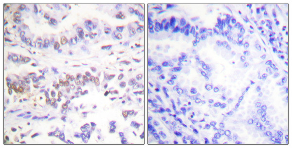 Immunohistochemistry analysis of paraffin-embedded human lung carcinoma tissue, using XRCC3 Antibody. The picture on the right is blocked with the synthesized peptide.