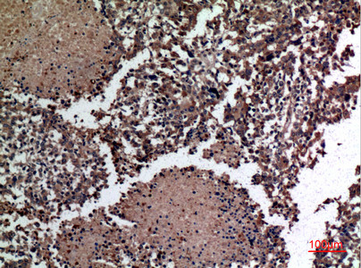 Immunohistochemical analysis of paraffin-embedded human-lung-cancer, antibody was diluted at 1:100