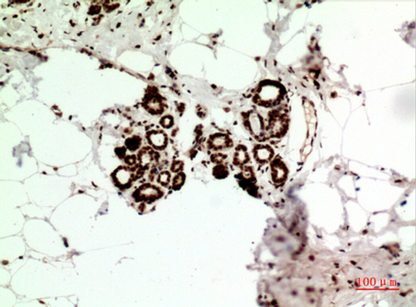 Immunohistochemical analysis of paraffin-embedded human-Breast-cancer, antibody was diluted at 1:100