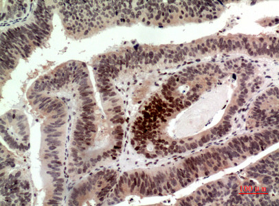 Immunohistochemical analysis of paraffin-embedded human-colon-cancer, antibody was diluted at 1:100