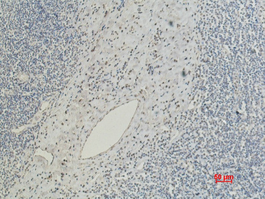 Immunohistochemical analysis of paraffin-embedded Human Tonsil Caricnoma using CD5 Mouse mAb diluted at 1:200.