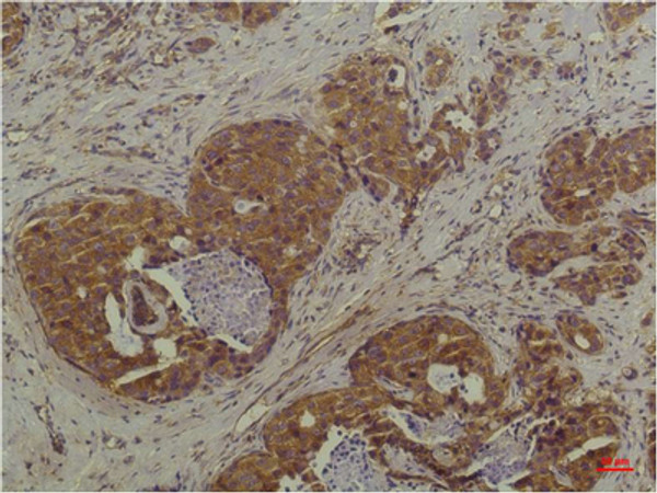 Immunohistochemical analysis of paraffin-embedded Human Breast Carcinoma using P44/42 MAPK (ERK1/2) Mouse mAb diluted at 1:200.