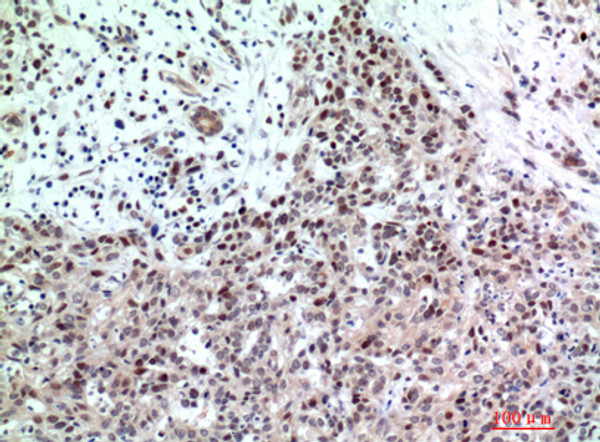 Immunohistochemical analysis of paraffin-embedded human-breast-cancer, antibody was diluted at 1:200