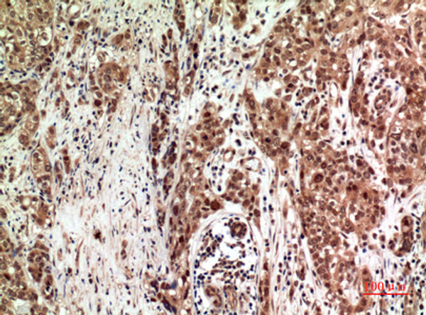 Immunohistochemical analysis of paraffin-embedded human-breast-cancer, antibody was diluted at 1:100