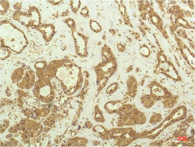 Immunohistochemical analysis of paraffin-embedded Human Breast Carcinoma Tissue using P70 S6 Kinase Mouse mAb diluted at 1:200.