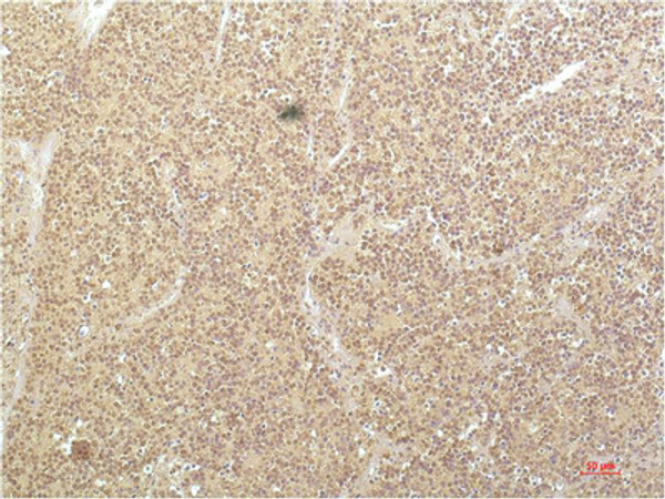 Immunohistochemical analysis of paraffin-embedded Human Kidney Carcinoma Tissue using SGK1 Mouse mAb diluted at 1:200.