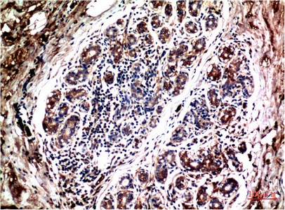 Immunohistochemical analysis of paraffin-embedded Human Breast Carcinoma Tissue using Akt Mouse mAb diluted at 1:200.