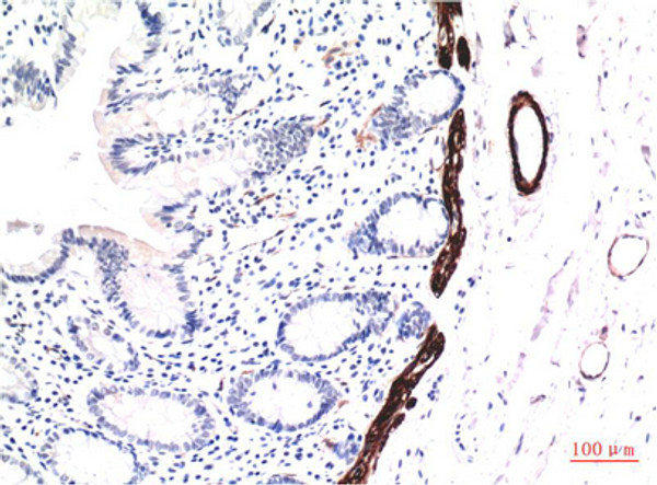 Immunohistochemical analysis of paraffin-embedded Human Colon Carcinoma Tissue using Muscle Actin Mouse mAb diluted at 1:200. Immunohistochemical analysis of paraffin-embedded Human Colon Carcinoma Tissue using Muscle Actin Mouse mAb diluted at 1:200.