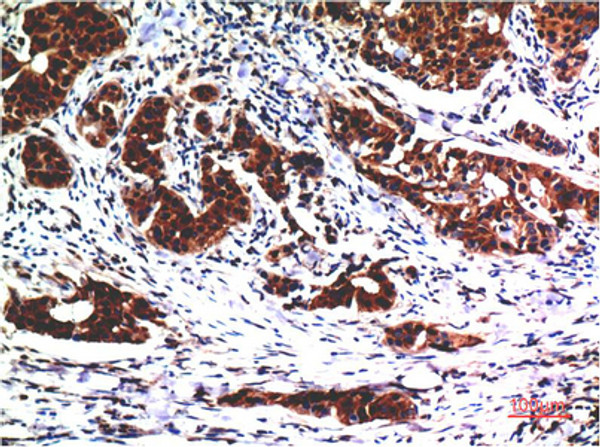 Immunohistochemical analysis of paraffin-embedded Human Breast Carcinoma Tissue using Akt Mouse mAb diluted at 1:200.