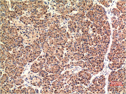 Immunohistochemical analysis of paraffin-embedded Human Pancreas Carcinoma Tissue using CHOP Mouse mAb diluted at 1:200.