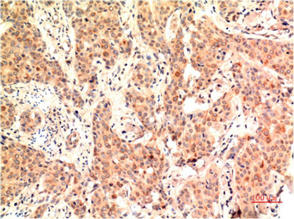 Immunohistochemical analysis of paraffin-embedded Human Breast Carcinoma Tissue using ERK1 Mouse mAb diluted at 1:200. Immunohistochemical analysis of paraffin-embedded Human Breast Carcinoma Tissue using ERK1 Mouse mAb diluted at 1:200.