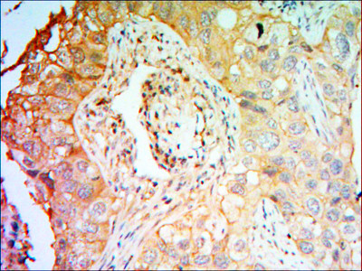 Immunohistochemistry analysis of paraffin-embedded lung cancer tissues with DAB staining using CCK-4 monoclonal antibody.