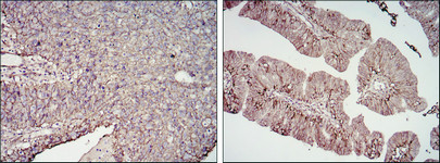 Immunohistochemistry analysis of paraffin-embedded cervical cancer tissues (left) and ovarian cancer tissues (right) with DAB staining using CD276 monoclonal antibody.