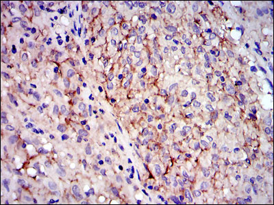 Immunohistochemistry analysis of paraffin-embedded malignant stromal tumors tissues with DAB staining using c-Kit monoclonal antibody.