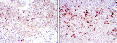 Immunohistochemistry analysis of paraffin-embedded cervical cancer tissues (left) and tonsil tissues (right) with DAB staining using Cortactin monoclonal antibody.