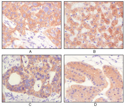 Immunohistochemistry analysis of paraffin-embedded human lung squamous cell carcinoma (A) , normal hepatocyte (B) , colon adenocacinoma (C) , normal stomach tissue (D) , showing cytoplasmic and membrane localization with DAB staining using Cytokeratin (Pan) M