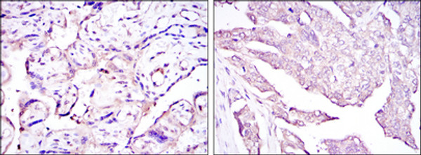 Immunohistochemistry analysis of paraffin-embedded placenta tissues (left) and ovarian cancer (right) with DAB staining using E7 monoclonal antibody.