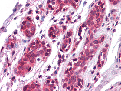 Immunohistochemistry analysis of paraffin-embedded human Breast tissues with AEC staining using EphA7 monoclonal antibody.