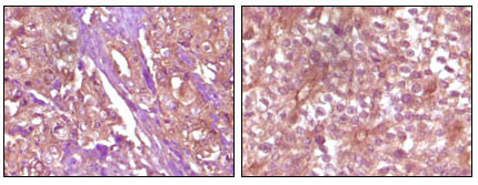 Immunohistochemistry analysis of paraffin-embedded Human pancreas carcinoma (left) and breast carcinoma (right) tissue, showing membrane and cytoplasmic (pancreas carcinoma) localization, membrane (breast carcinoma) localization with DAB staining using Ep