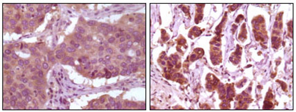 Immunohistochemistry analysis of paraffin-embedded human lung carcinoma (left) and breast carcinoma (right) showing cytoplasmic localization with DAB staining using ERK 2 monoclonal antibody. Immunohistochemistry analysis of paraffin-embedded human lung carcinoma (left) and breast carcinoma (right) showing cytoplasmic localization with DAB staining using ERK 2 monoclonal antibody.