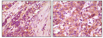 Immunohistochemistry analysis of paraffin-embedded human stomach carcinoma (left) and breast carcinoma (right) , showing cytoplasmic localization with DAB staining using Fibulin-5 monoclonal antibody.