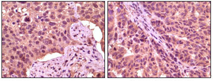 Immunohistochemistry analysis of paraffin-embedded human lung carcinoma (left) and skin carcinoma (right) , showing cytoplasmic localization with DAB staining using GSK3 Alpha monoclonal antibody.