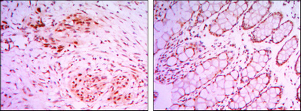 Immunohistochemistry analysis of paraffin-embedded colon cancer tissues (left) and human larynx cancer tissues (right) with DAB staining using JMJD2A monoclonal antibody.