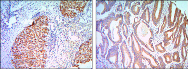 Immunohistochemistry analysis of paraffin-embedded liver cancer (right) and colon cancer tissues (left) with DAB staining using KLHL11 monoclonal antibody.