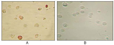 Immunocytochemistry analysis of TPA induced BCBL-1 cells (A) and uninduced BCBL-1 cells (B) using KSHV ORF45 monoclonal antibody with AEC staining.