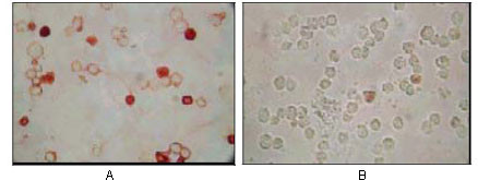 Immunocytochemistry analysis of TPA induced BCBL-1 cells (A) and uninduced BCBL-1 cells (B) using KSHV ORF62 monoclonal antibody with AEC staining.