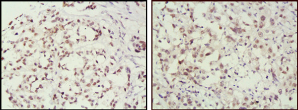 Immunohistochemistry analysis of paraffin-embedded human breast cancer (left) and lung cancer (right) tissues, showing nuclear localization with DAB staining using MSH2 monoclonal antibody.