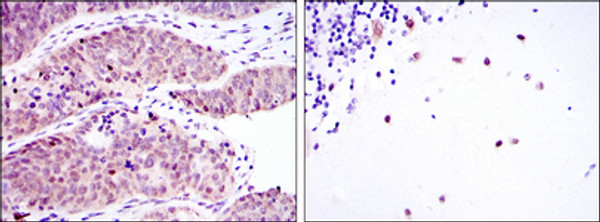 Immunohistochemistry analysis of paraffin-embedded ovarian cancer (left) and cerebellum tissues (right) with DAB staining using Msi2 monoclonal antibody.