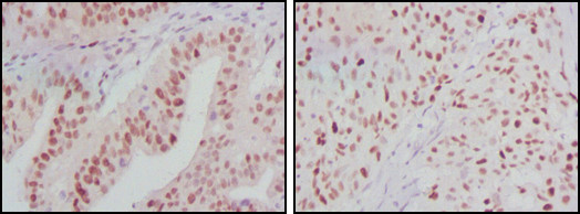 Immunohistochemistry analysis of paraffin-embedded human ovarian cancer (left) and breast cancer (right) tissues with DAB staining using PMR1 monoclonal antibody.