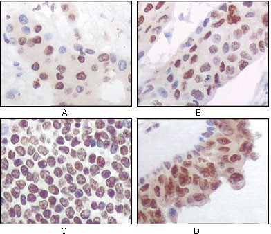 Immunohistochemistry analysis of paraffin-embedded human liver carcinoma (A) , esophagus carcinoma (B) , normal spleen tissue (C) , breast carcinoma (D) , showing nuclear and cytoplasmic localization with DAB staining using PRAK monoclonal antibody.