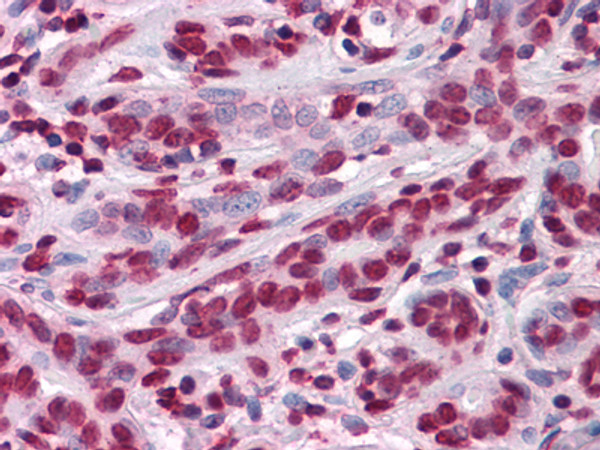 Immunohistochemistry analysis of paraffin-embedded human Breast tissues with AEC staining using TH-POK monoclonal antibody.