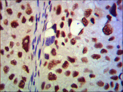 Immunohistochemistry analysis of paraffin-embedded human lung cancer using LSD1 monoclonal antibody.