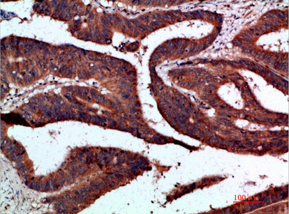 Immunohistochemical analysis of paraffin-embedded human-colon-cancer, antibody was diluted at 1:200