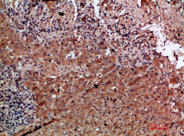Immunohistochemical analysis of paraffin-embedded human-liver-cancer, antibody was diluted at 1:200