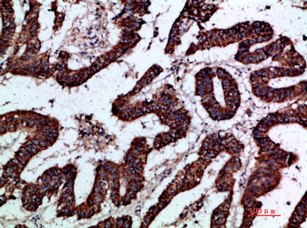 Immunohistochemical analysis of paraffin-embedded human-colon-cancer, antibody was diluted at 1:200