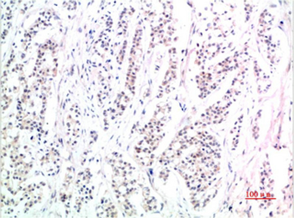 Immunohistochemical analysis of paraffin-embedded Human Stomach Carcinoma Tissue using Phospho-Smad3 (S425) Mouse mAb diluted at 1:200 Immunohistochemical analysis of paraffin-embedded Human Stomach Carcinoma Tissue using Phospho-Smad3 (S425) Mouse mAb diluted at 1:200