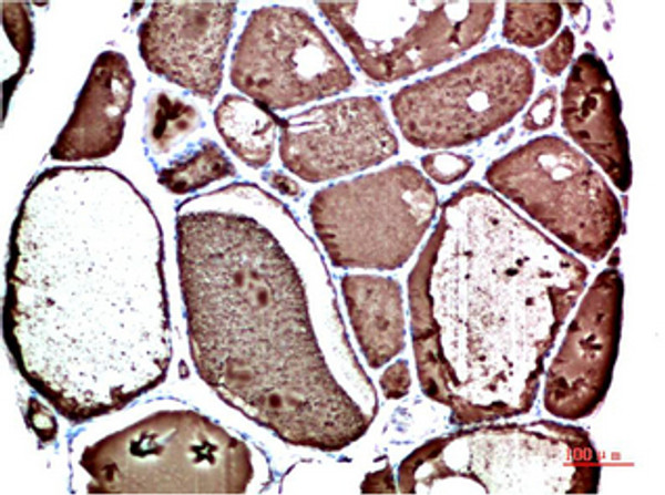 Immunohistochemical analysis of paraffin-embedded Human Thyroid Tissue using TTR Mouse mAb diluted at 1:200 Immunohistochemical analysis of paraffin-embedded Human Thyroid Tissue using TTR Mouse mAb diluted at 1:200