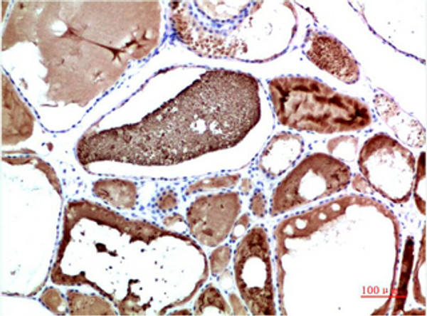 Immunohistochemical analysis of paraffin-embedded Human Liver Carcinoma Tissue using TTR Mouse mAb diluted at 1:200 Immunohistochemical analysis of paraffin-embedded Human Liver Carcinoma Tissue using TTR Mouse mAb diluted at 1:200