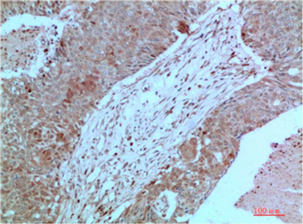 Immunohistochemical analysis of paraffin-embedded Human Breast Carcinoma Tissue using JAK2 Mouse mAb diluted at 1:200