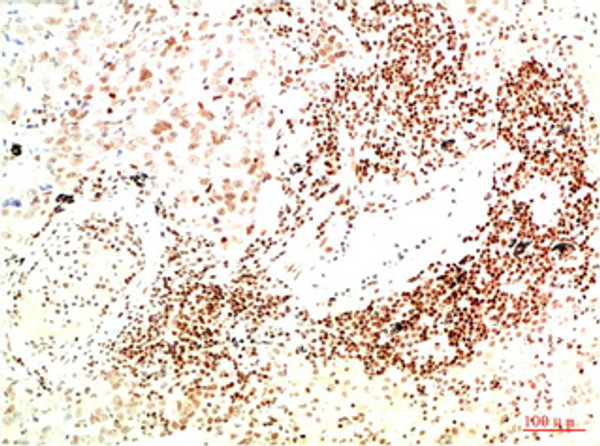 Immunohistochemical analysis of paraffin-embedded Human Lung Carcinoma Tissue using JAK2 Mouse mAb diluted at 1:200