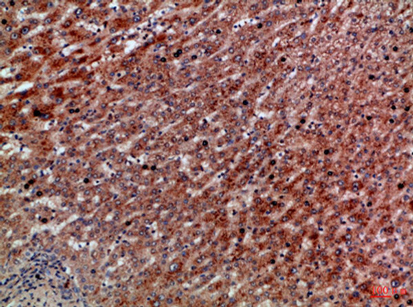 Immunohistochemical analysis of paraffin-embedded Human-liver-cancer, antibody was diluted at 1:100